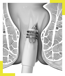 Hemorrhoid Surgery