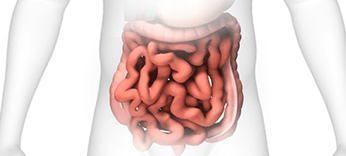 Intestinal Perforation